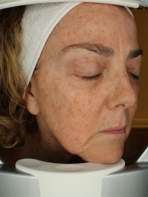 After lifting treatment