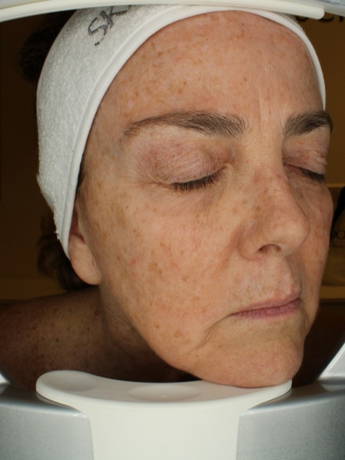 Before lifting treatment