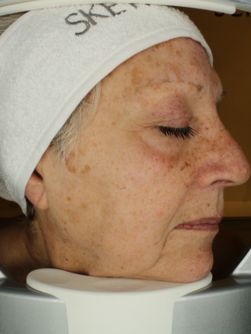 After lifting treatment