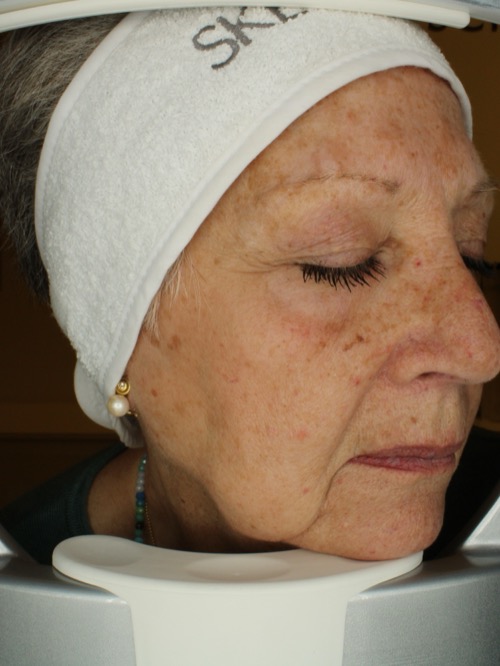 Before lifting treatment