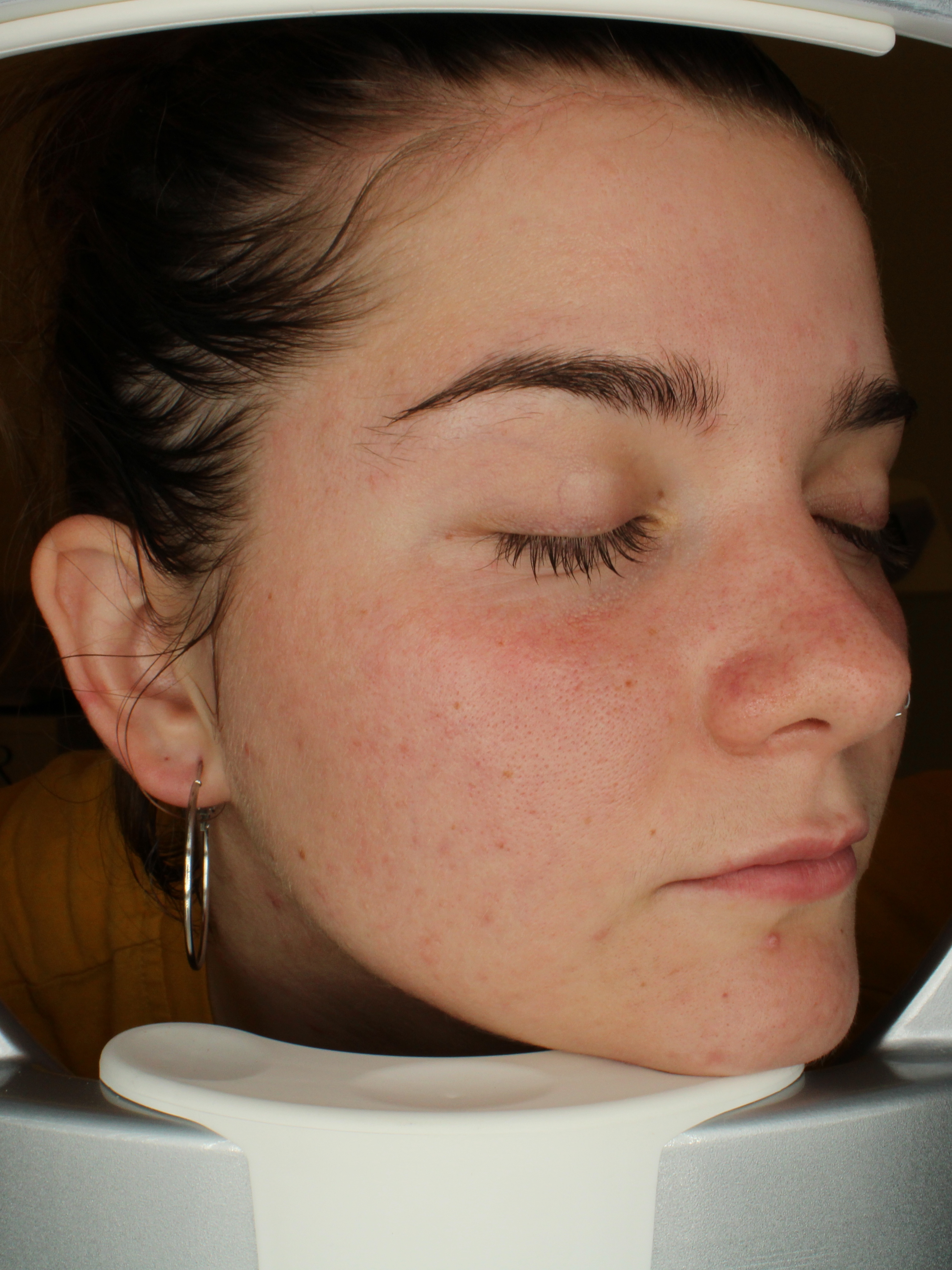 Skin Clarity - After