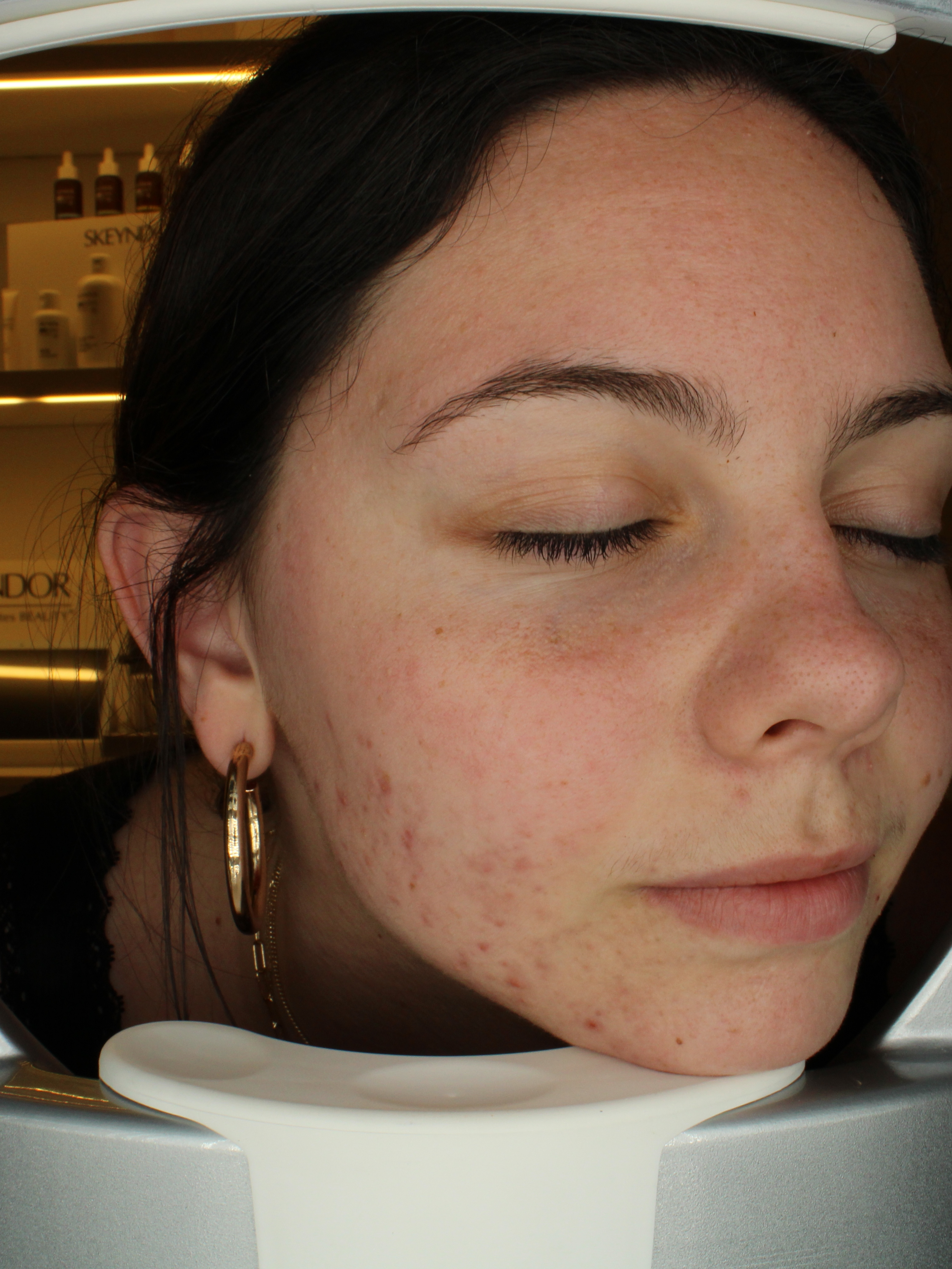 Pore Refining - Before